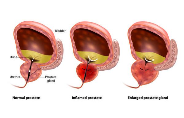 prostatitas yra prostatos uždegimas