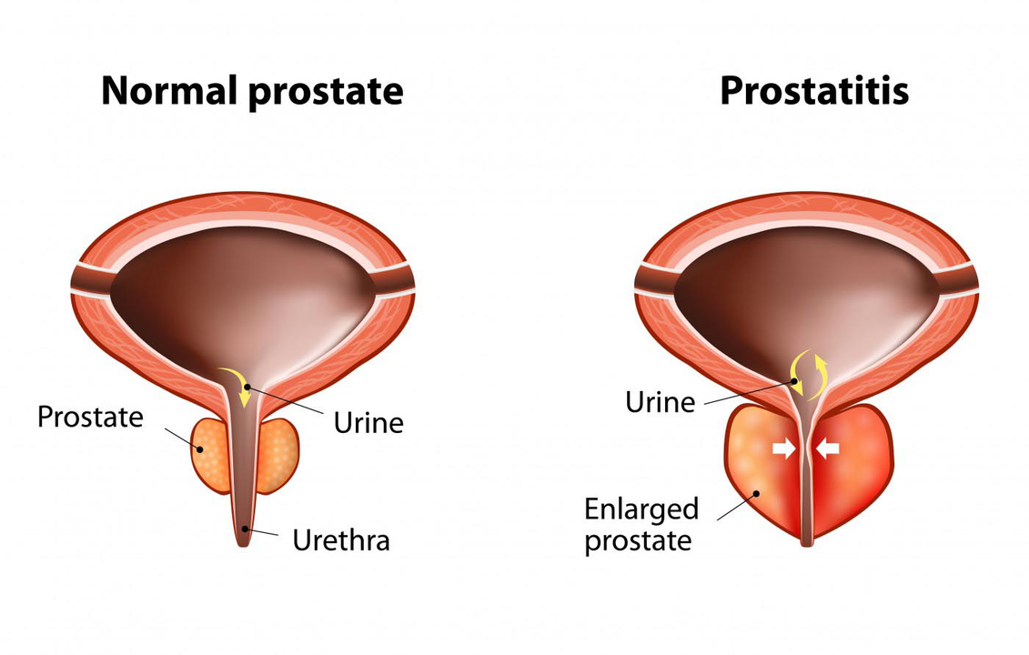 Sveiko vyro normali prostata ir prostatos uždegimas su prostatitu